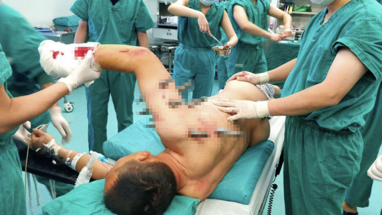 “Burri i çeliktë”: Kinezi shpëton, edhe pse në trupin e tij ishin ngulur 10 shufra hekuri (Foto)