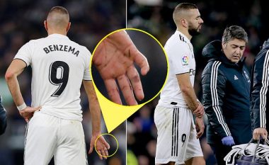 Benzema pritet t’i shpëtojë operimit, ende nuk dihet sa do të mungojë