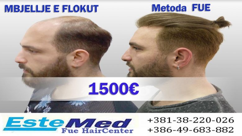 Metoda FUE për mbjelljen e flokëve nga ‘ESTEMED Medical Center’