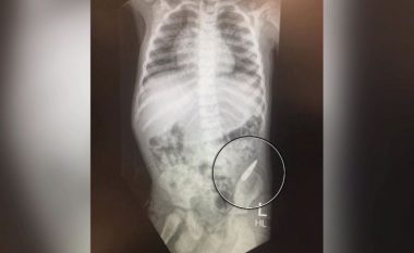 Në trupin e trevjeçarit mjekët gjejnë plumb, prindërit besojnë se e kishte gëlltitur (Foto)