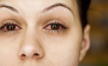 Sytë tregojnë këto sëmundje në trupin tonë