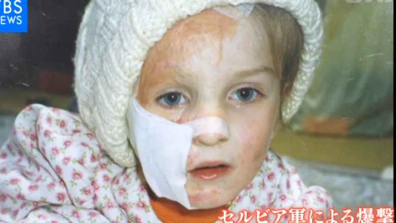 Japonezët ia shpëtuan jetën vajzës nga Kosova – gjatë luftës kishe pësuar djegie të rëndë në fytyrë (Video)