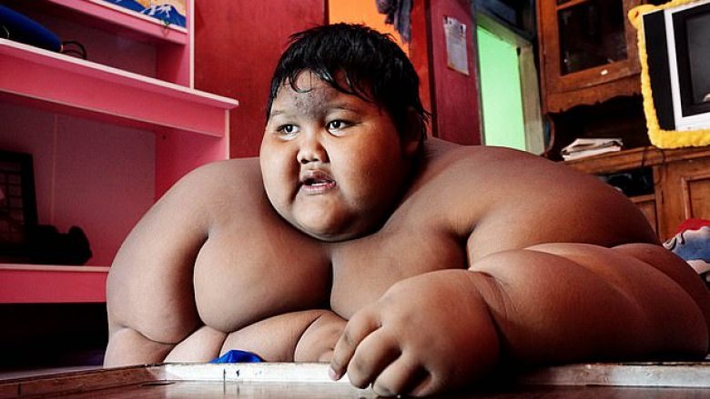 Si 13-vjeçar peshonte 192 kilogramë, pas dietave dhe ngushtimit të lukthit humbi gjysmën e peshës – tani pritet ta heq edhe lëkurën e tepërt (Foto)