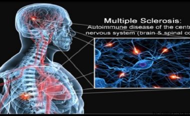Mbi 1 mijë persona vuajnë nga “Multiple Skleroza” në Maqedoni