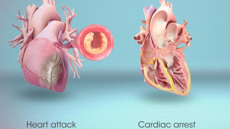 Arresti kardiak dhe sulmi në zemër: Dallimet mes këtyre dyjave dhe si duhet të reagoni