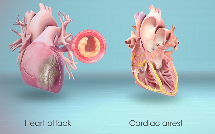 Arresti kardiak dhe sulmi në zemër: Dallimet mes këtyre dyjave dhe si duhet të reagoni