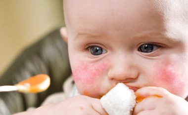 Reaksioni alergjik te fëmijët kërkon intervenim të shpejtë