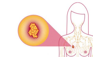 Armiku numër një i grave:  Kolesteroli i keq stimulon rritjen e qelizave të kancerit të gjirit