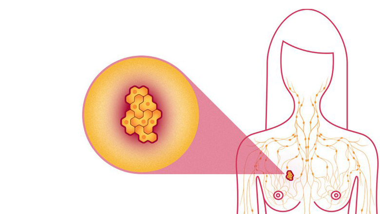 Armiku numër një i grave:  Kolesteroli i keq stimulon rritjen e qelizave të kancerit të gjirit