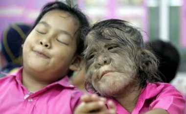 Morën ilaçe të kontaminuara, 16 fëmijë në Spanjë preken nga ‘sindroma ujk’