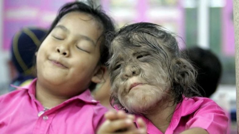 Morën ilaçe të kontaminuara, 16 fëmijë në Spanjë preken nga ‘sindroma ujk’