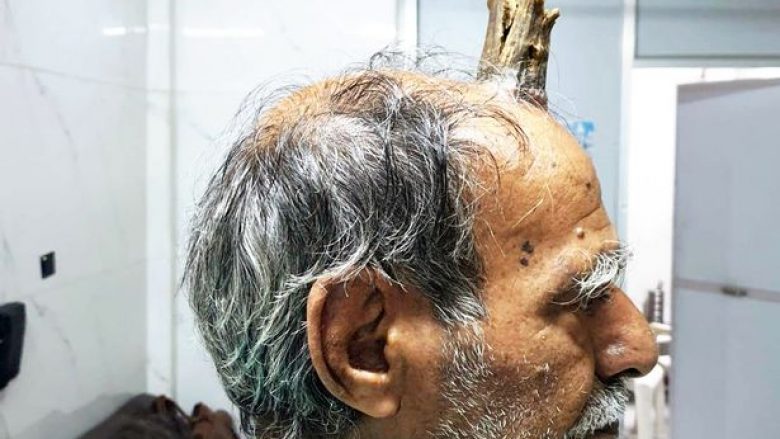Kishte filluar t’i shfaqej para pesë vitesh, burrit në Indi i hiqet “briri i djallit” nga koka