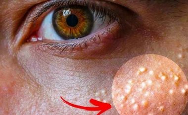 Nëse keni pika të bardha përreth syve nuk duhet assesi t’i “shtrydhni”: Me këtë metodë mund t’i eliminoni