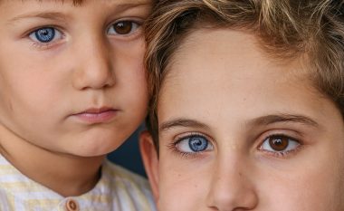 Vëllezërit turq befasojnë me ngjyrat e syve, shkaku i gjendjes së rrallë njërin sy e kanë të kaltër e tjetrin ngjyrëkafe