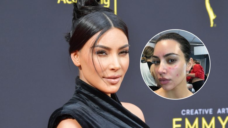 Kim Kardashian po vuan nga një sëmundje e rrallë e lëkurës