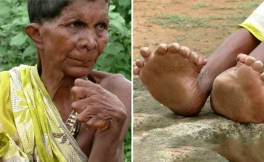 “Fqinjët besojnë se jam shtrigë”, historia e trishtë e pensionistes me 32 gishta