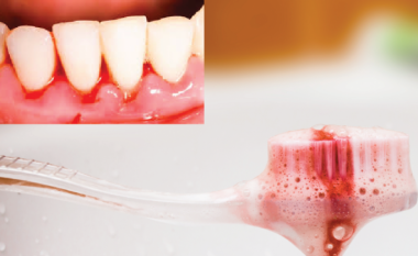 Çfarë paralajmëron gjakosja e mishrave të dhëmbëve gjatë shtatzënisë: Rastet kur duhet të shqetësoheni