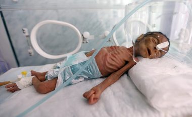 Gjendja e rëndë shëndetësore e një fëmijë të keq ushqyer, tregon pasojat e konfliktit pesëvjeçar në Jemen