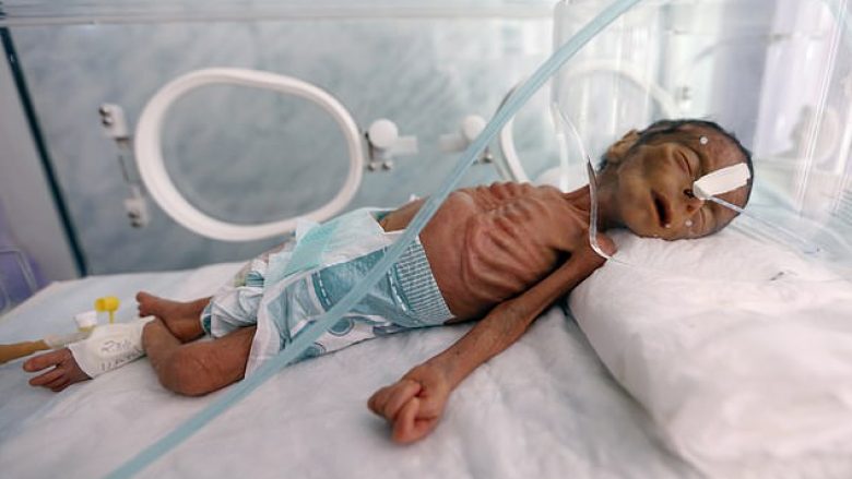 Gjendja e rëndë shëndetësore e një fëmijë të keq ushqyer, tregon pasojat e konfliktit pesëvjeçar në Jemen