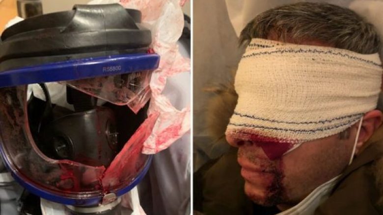 Fotoreporteri rrezikon të humbasë syrin, pasi goditet nga bombola e gazit e policisë në Francë