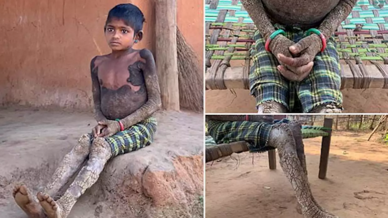 Vajza e vogël shndërrohet në gur, për shkak të një sëmundje të rrallë të pashërueshme të lëkurës