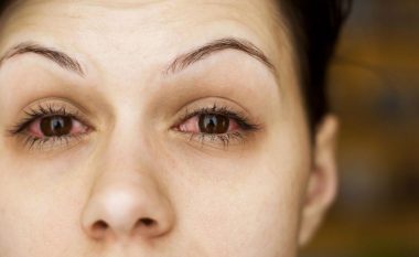 Ekspertët: Coronavirusi i kthen sytë e pacientëve në sy rozë