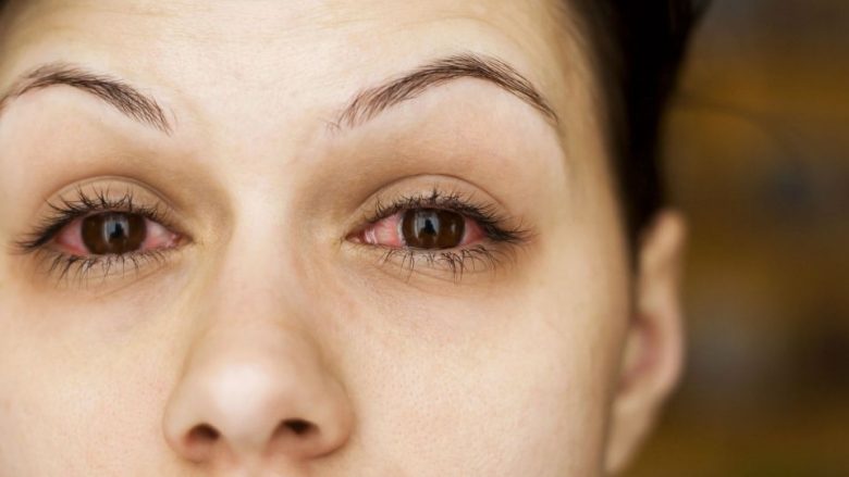 Ekspertët: Coronavirusi i kthen sytë e pacientëve në sy rozë