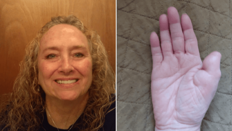 Humbi gishtin e dorës nga kanceri i lëkurës – mjekët ia transplantojnë gishtin e madh të këmbës