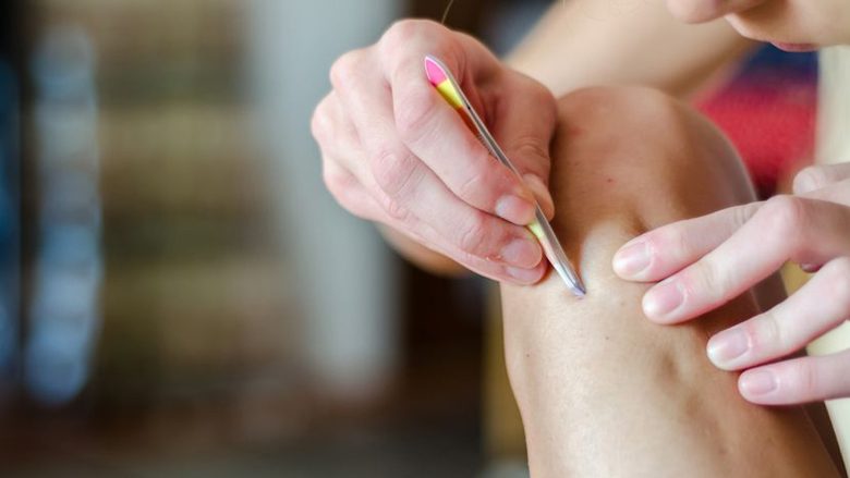 Dermatologët propozojnë tri mënyra të eliminimit të qimeve në shtëpi