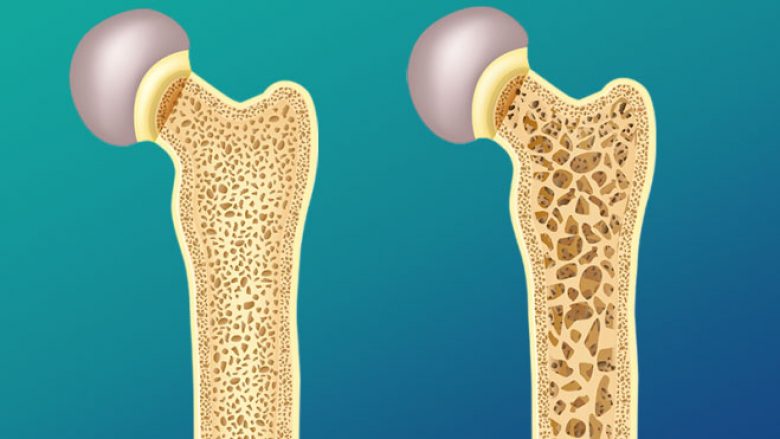Osteoporoza dhe marramendja