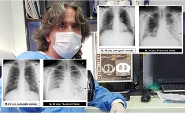 Radiologu Krasniqi tregon pamjet e mushkërive të pacientëve me COVID-19: Virus ka, pandemi ka dhe situata nuk është e mirë
