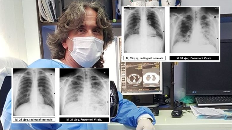 Radiologu Krasniqi tregon pamjet e mushkërive të pacientëve me COVID-19: Virus ka, pandemi ka dhe situata nuk është e mirë