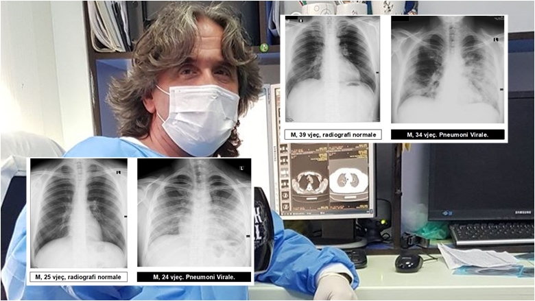 Radiologu Krasniqi tregon pamjet e mushkërive të pacientëve me COVID-19