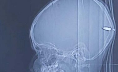 ​Djali papritmas bëhet i përgjumur, mjekët gjetën plumb në kokën e palestinezit 9-vjeç