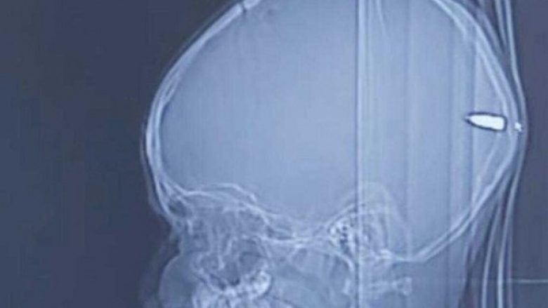 ​Djali papritmas bëhet i përgjumur, mjekët gjetën plumb në kokën e palestinezit 9-vjeç