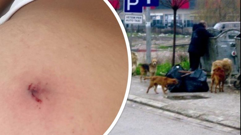 Qentë endacakë sulmojnë një fëmijë 12-vjeçar, nëna e tij thotë se do të padis Komunën e Prishtinës