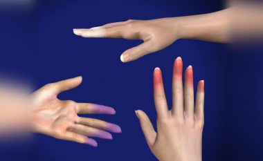 Këto janë simptomat e sëmundjes që shkakton gishtërinjtë e bardhë ose të kaltër