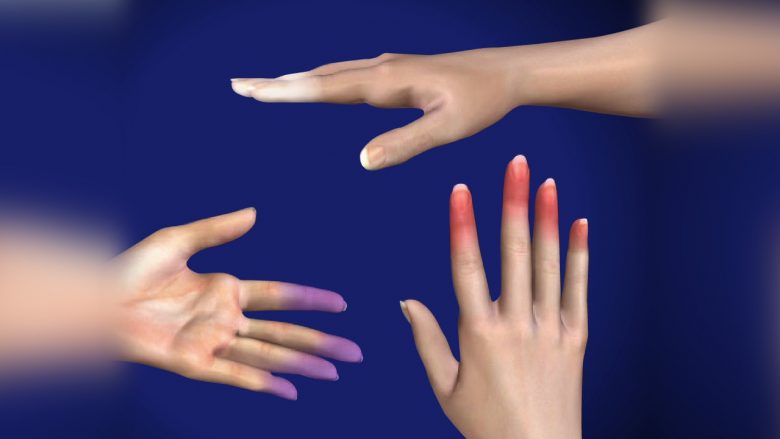 Këto janë simptomat e sëmundjes që shkakton gishtërinjtë e bardhë ose të kaltër