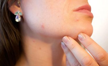 20 këshilla të shpejta për fytyrë pa akne, sugjeruar nga dermatologë