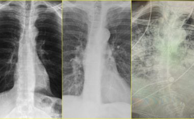 Specialistja publikon fotografitë e rëntgenit – dallimi ndërmjet mushkërive të atyre që konsumojnë duhan dhe atyre të prekur nga COVID-19