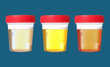 Cila ngjyrë e urinës është një shenjë e sëmundjeve të rrezikshme