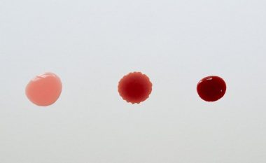 Nga infeksionet te kanceri: Çfarë e shkakton gjakderdhjen pas seksit?