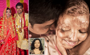 Gruaja e mbijetuar nga sulmi me acid kur ishte 15 vjeçe, gjen dashurinë e martohet 13 vjet më vonë