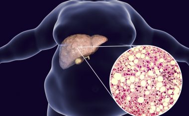 Sëmundja e mëlçisë yndyrore: Tri shenja në këmbë që mund të tregojnë rrezikun e sëmundjes