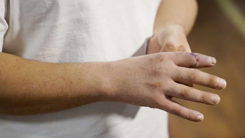 Kirurgu turk “ia kthen gishtin e dorës në vend” pacientit të tij, 19 orë pasi ai e kishte “këputur”