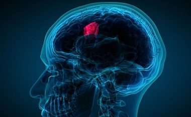 Tumori në tru: Shtatë simptoma që duhet të njihen 
