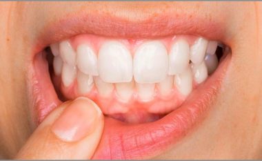 Gjakderdhja nga mishi i dhëmbëve mund të jetë një shenjë e mungesës së vitaminës C