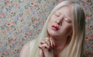 Modelja albine që u braktis nga prindërit, vazhdon të thyejë rekorde me imazhet e saj