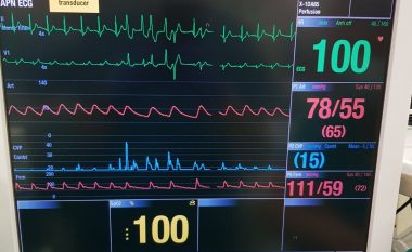 Realizohet edhe një transplantim i zemrës në Maqedoninë e Veriut