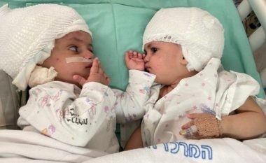Binjakët “e bashkuar kokë më kokë” janë ndarë pas një operacioni të rrallë në Izrael